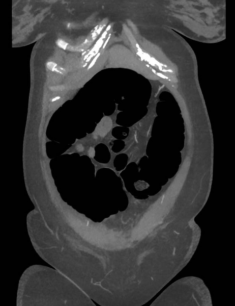 File:Colonic pseudo-obstruction (Radiopaedia 79752-92980 B 18).png