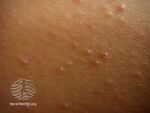 Keratosis pilaris (DermNet NZ acne-keratosis-pilaris-3016).jpg