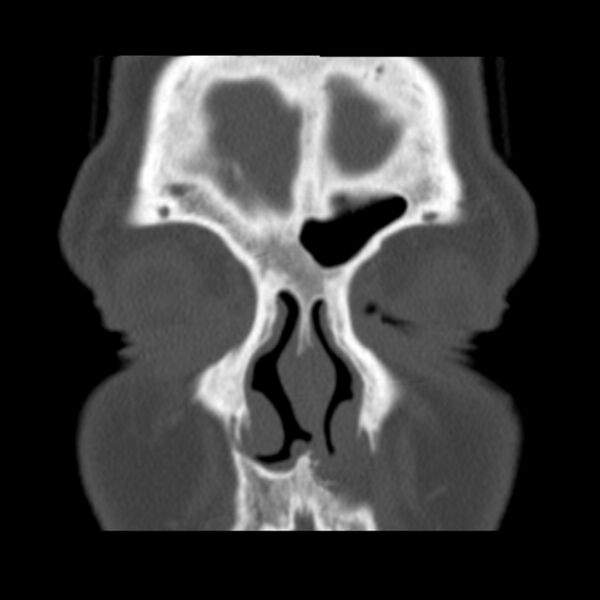 File:Nasolabial cyst (Radiopaedia 33987-35205 Coronal bone window 24).jpg