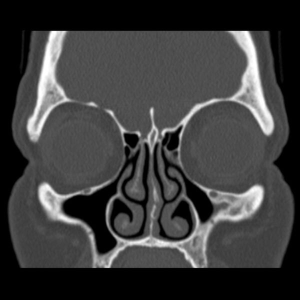File:Nasolabial cyst (Radiopaedia 33987-35205 Coronal bone window 31).jpg