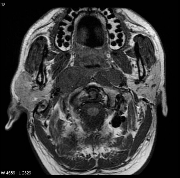 File:Nasopharyngeal carcinoma (Radiopaedia 4546-6667 Axial T1 11).jpg