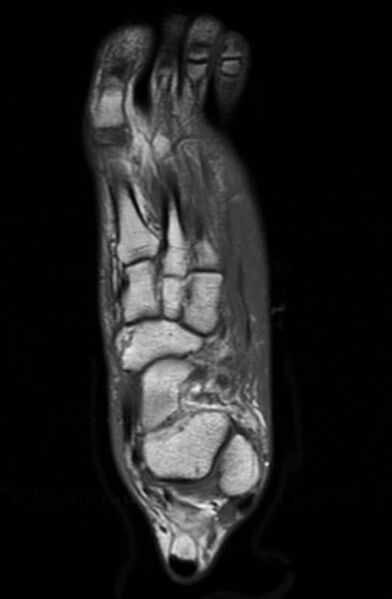 File:Navicular fracture (Radiopaedia 11662-12025 Axial T1 1).jpg