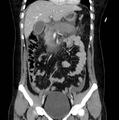 Necrotizing pancreatitis (Radiopaedia 23001-23031 B 27).jpg