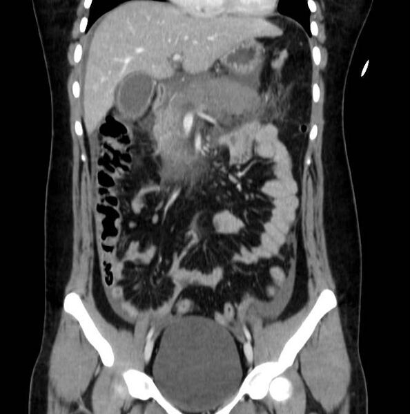 File:Necrotizing pancreatitis (Radiopaedia 23001-23031 B 27).jpg