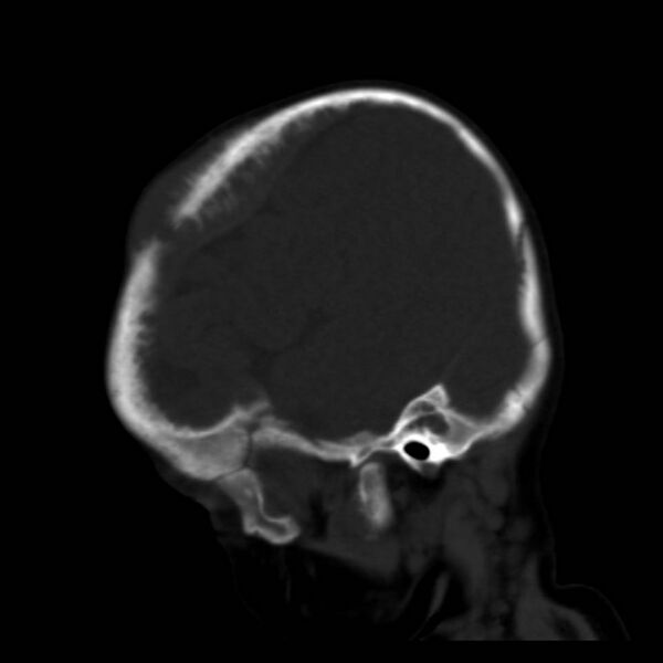 File:Neuroblastoma with skull metastases (Radiopaedia 30326-30958 Sagittal bone window 8).jpg