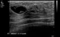 Neurofibromatosis of breast (Radiopaedia 5921-7462 G 1).jpg