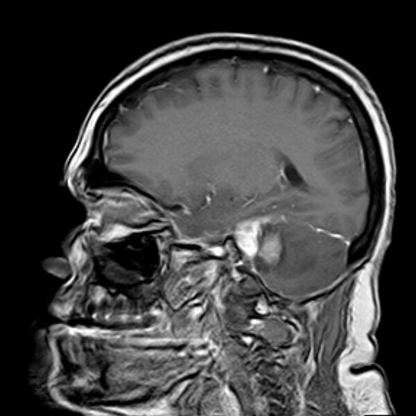 File:Neurofibromatosis type 2 (Radiopaedia 67470-76871 Sagittal T1 C+ 12).jpg