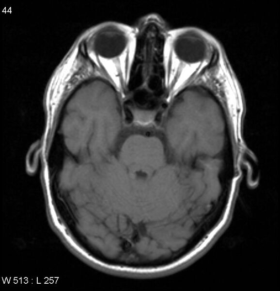 File:Neurosarcoidosis (Radiopaedia 10930-17204 Axial T1 6).jpg