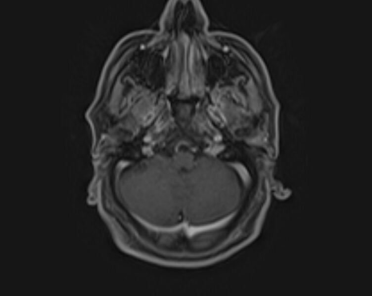 File:Non-Hodgkin lymphoma - parotid gland (Radiopaedia 71531-81890 E 45).jpg