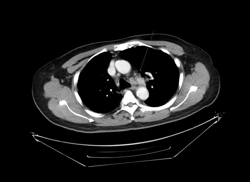 File:Non-Hodgkin lymphoma involving seminal vesicles with development of interstitial pneumonitis during Rituximab therapy (Radiopaedia 32703-33677 Annotated CT 2).jpg