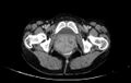 Non-puerperal uterine inversion (Radiopaedia 78343-91094 A 81).jpg