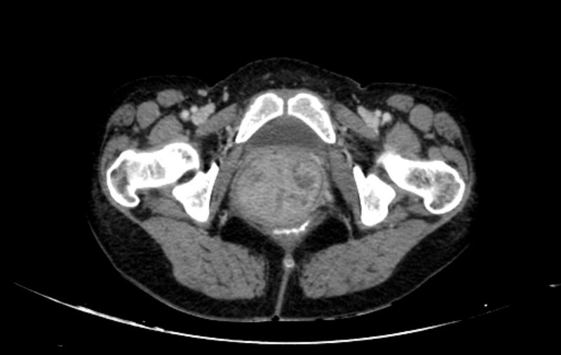 File:Non-puerperal uterine inversion (Radiopaedia 78343-91094 A 81).jpg