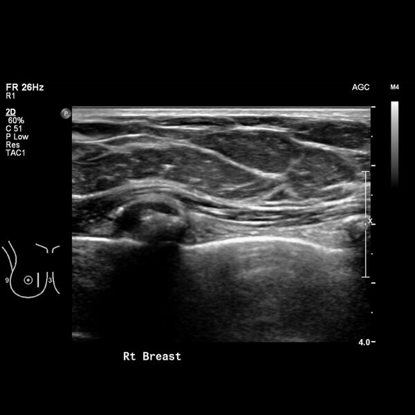 File:Normal breast mammography (tomosynthesis) and ultrasound (Radiopaedia 65325-74354 Right breast 5).jpeg