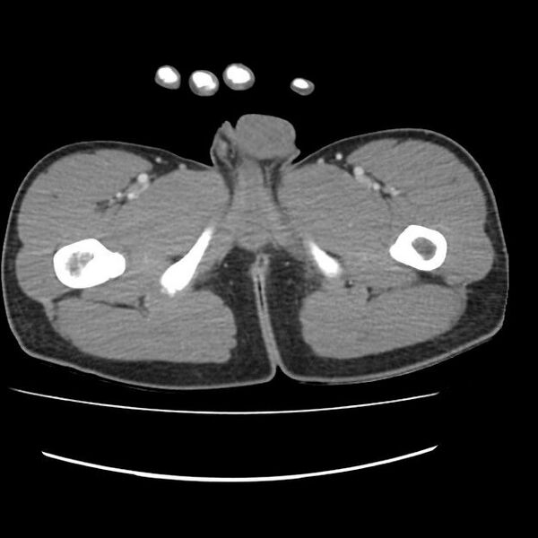 File:Normal dual-phase trauma CT chest,abdomen and pelvis (Radiopaedia 48092-52899 A 123).jpg