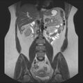 Normal liver MRI with Gadolinium (Radiopaedia 58913-66163 Coronal T2 23).jpg