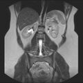 Normal liver MRI with Gadolinium (Radiopaedia 58913-66163 Coronal T2 27).jpg