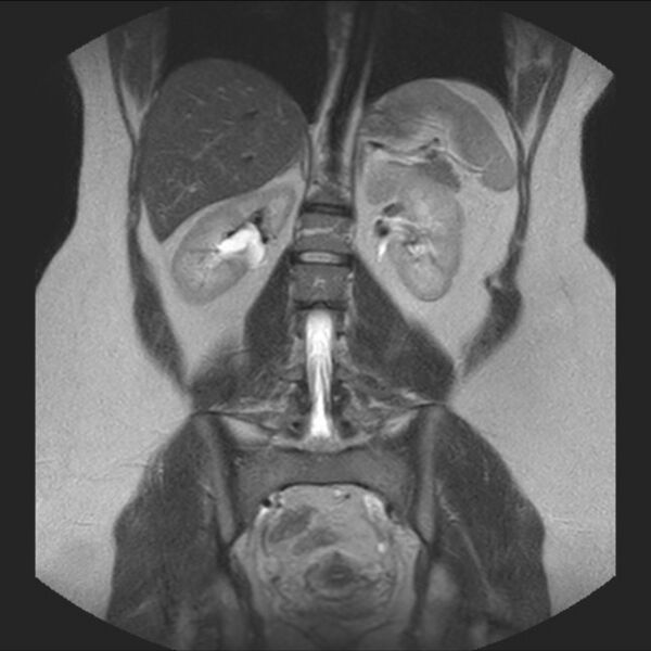 File:Normal liver MRI with Gadolinium (Radiopaedia 58913-66163 Coronal T2 27).jpg