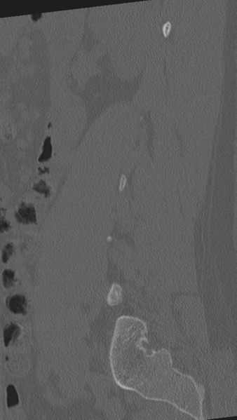 File:Normal lumbar spine CT (Radiopaedia 46533-50986 Sagittal bone window 24).png