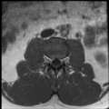 Normal lumbar spine MRI (Radiopaedia 35543-37039 Axial T1 29).png