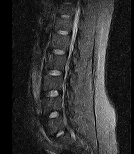 File:Normal lumbar spine MRI - low-field MRI scanner (Radiopaedia 40976-43699 Sagittal STIR 8).jpg