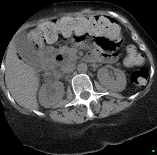 File:Obstructed infected horseshoe kidney (Radiopaedia 18116-17898 non-contrast 6).jpg