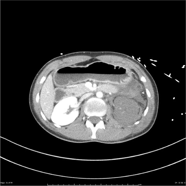 File:Traumatic renal artery dissection and pancreatic transection (Radiopaedia 37061-38739 Axial 241).jpg