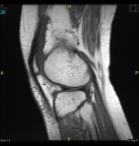 File:ACL mucoid degeration with cystic changes (Radiopaedia 48428-53341 Sagittal T1 18).jpg