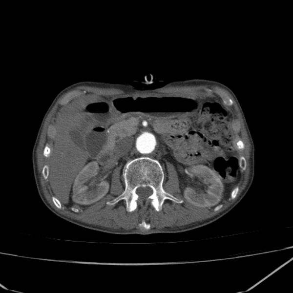 File:Abdominal aortic aneurysm (Radiopaedia 23703-23856 Axial C+ arterial phase 27).jpg