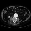 Abdominal aortic aneurysm (Radiopaedia 25855-26001 Axial C+ arterial phase 74).jpg