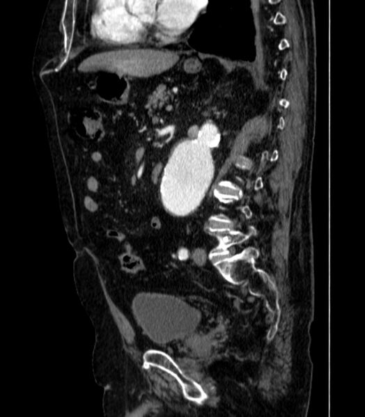 File:Abdominal aortic aneurysm (Radiopaedia 25855-26001 Sagittal C+ arterial phase 36).jpg