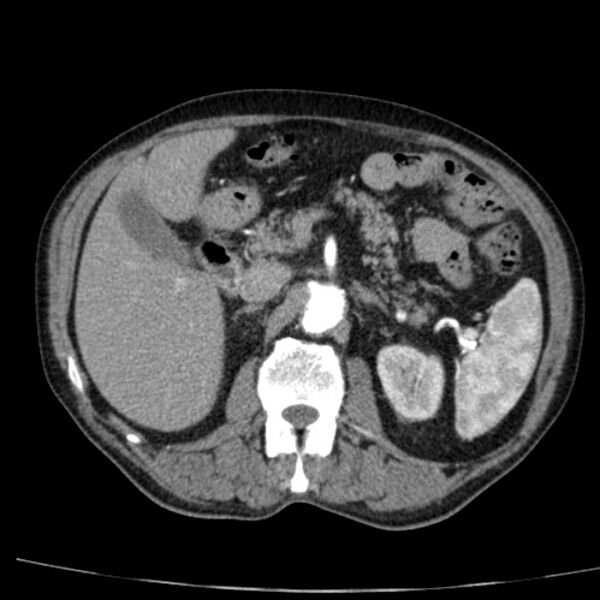 File:Abdominal aortic aneurysm (Radiopaedia 29248-29660 Axial C+ arterial phase 29).jpg