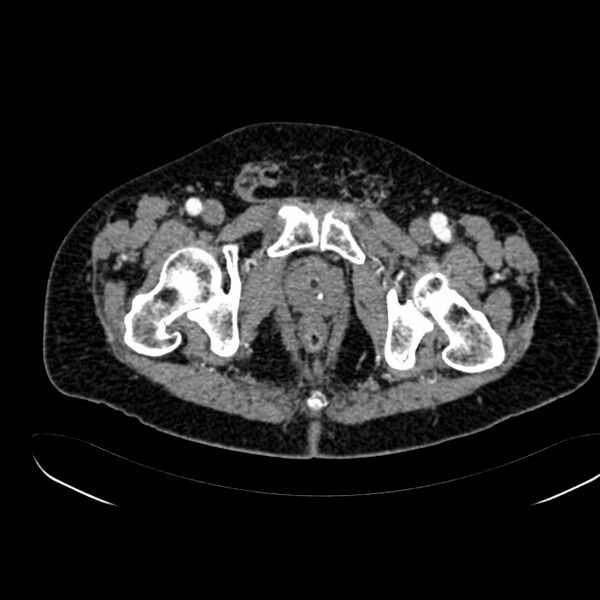 File:Abdominal aortic aneurysm (Radiopaedia 75131-86203 Axial C+ arterial phase 47).jpg