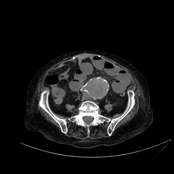 File:Abdominal aortic aneurysm - impending rupture (Radiopaedia 19233-19246 Axial non-contrast 85).jpg