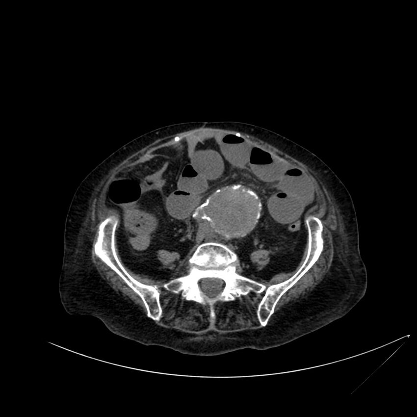 Abdominal aortic aneurysm - impending rupture (Radiopaedia 19233-19246 Axial non-contrast 85).jpg