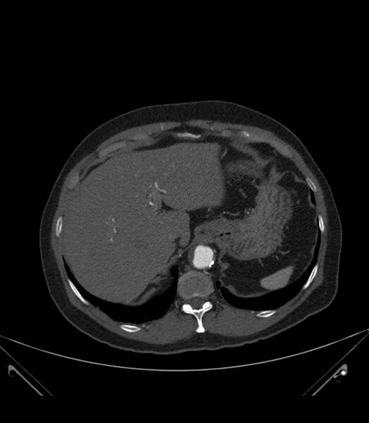 File:Abdominal aortic aneurysm with thrombus fissuration (Radiopaedia 46218-50618 Axial C+ arterial phase 7).jpg