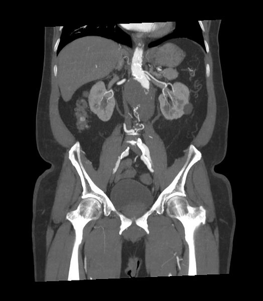 File:Abdominal aortic aneurysm with thrombus fissuration (Radiopaedia 46218-50618 Coronal C+ arterial phase 17).jpg