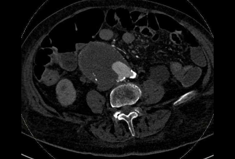 File:Abdominal aortic aneurysm with thrombus fissuration (Radiopaedia 73192-83919 Axial C+ arterial phase 130).jpg