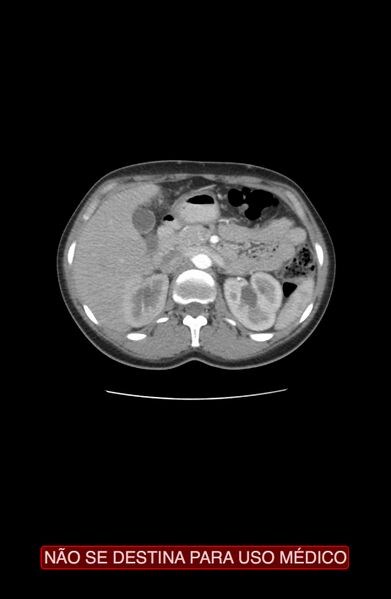 File:Abdominal desmoid tumor (Radiopaedia 44024-47540 Axial C+ arterial phase 1).jpg