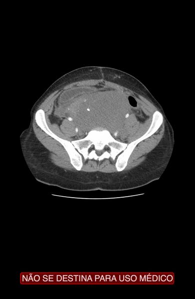 File:Abdominal desmoid tumor (Radiopaedia 44024-47540 Axial C+ arterial phase 31).jpg
