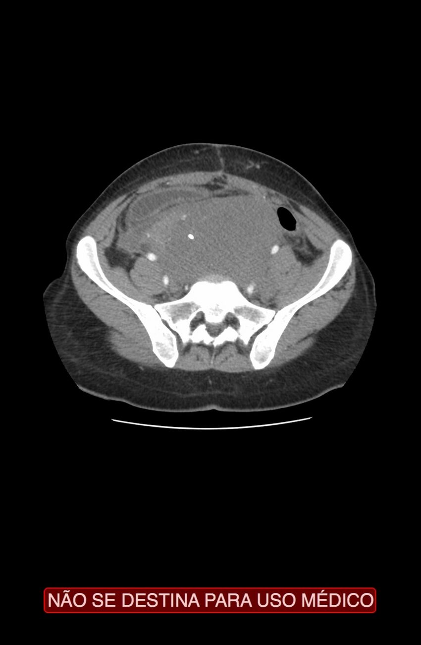 Abdominal desmoid tumor (Radiopaedia 44024-47540 Axial C+ arterial phase 31).jpg