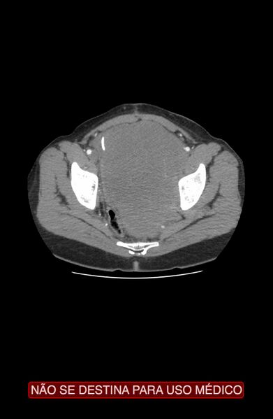 File:Abdominal desmoid tumor (Radiopaedia 44024-47540 Axial C+ arterial phase 45).jpg