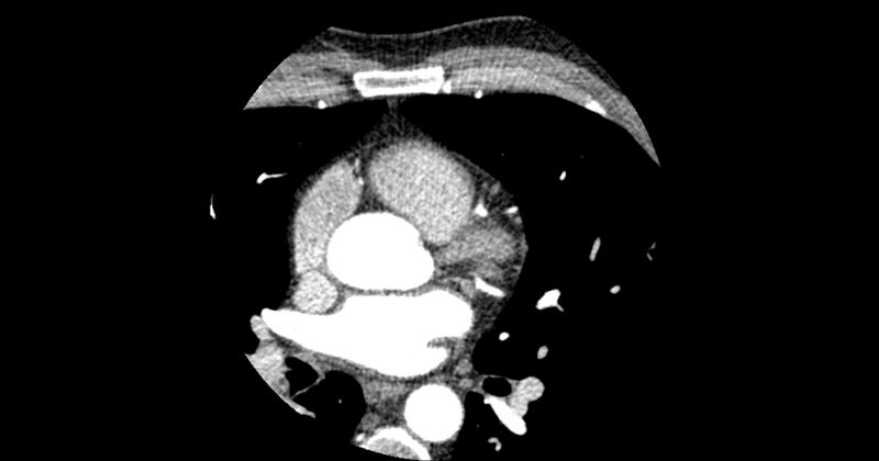 File:Aberrant left main coronary artery (ALMCA) arising from the right sinus with interarterial course (Radiopaedia 63251-71814 Axial C+ arterial phase 60).JPG