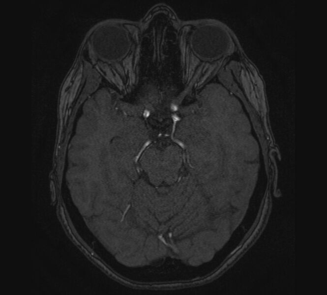 File:Accessory middle cerebral artery and ICA aneurysm (Radiopaedia 22656-22674 MRA 40).jpg