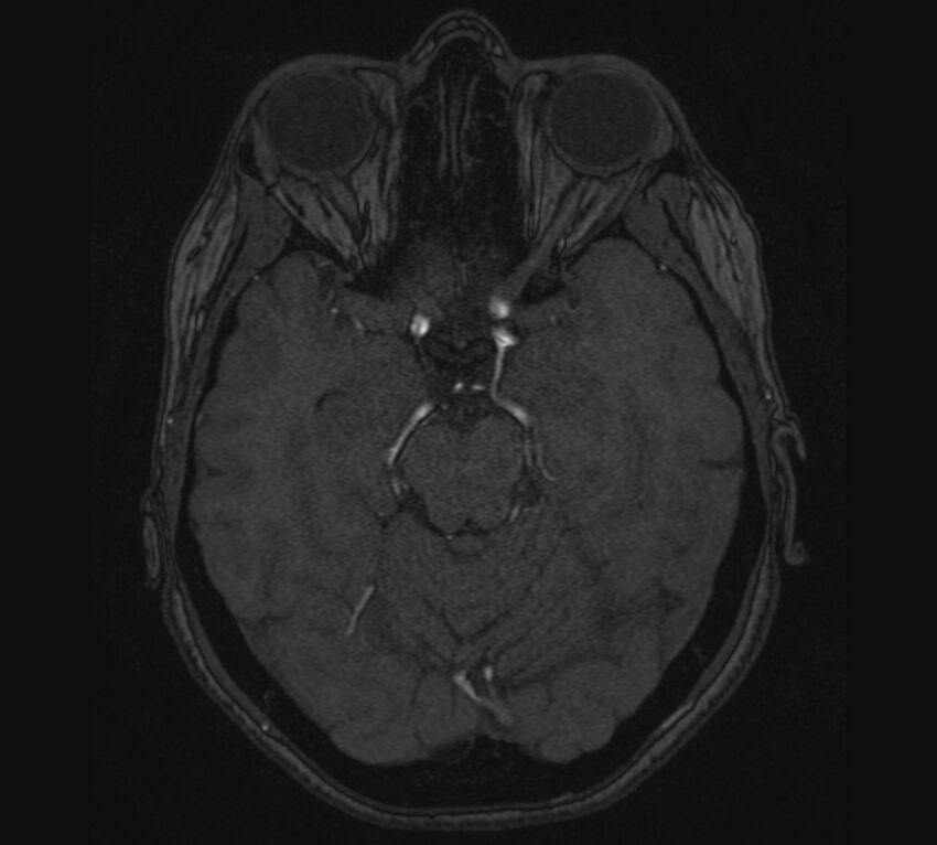 Accessory middle cerebral artery and ICA aneurysm (Radiopaedia 22656-22674 MRA 40).jpg