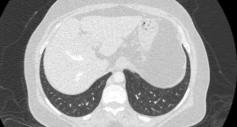 File:Accessory right inferior hepatic vein (Radiopaedia 65245-74259 Axial lung window 67).jpg