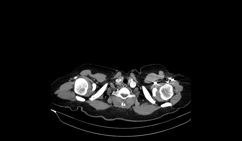 File:Acquired tracheo-esophageal fistula (Radiopaedia 51356-57103 Axial C+ arterial phase 4).jpg