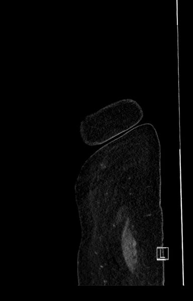 File:Active Crohn disease (Radiopaedia 59394-66750 Sagittal C+ portal venous phase 1).jpg