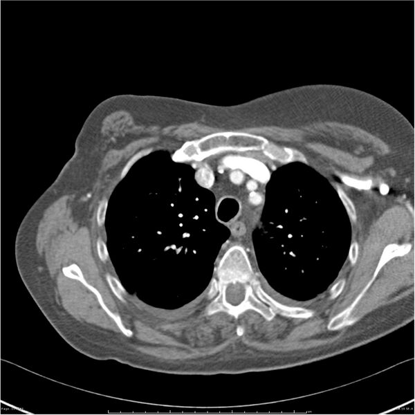 File:Acute-on-chronic pulmonary emboli (Radiopaedia 27925-28169 C+ CTPA 19).jpg