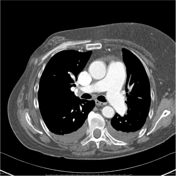 File:Acute-on-chronic pulmonary emboli (Radiopaedia 27925-28169 C+ CTPA 34).jpg