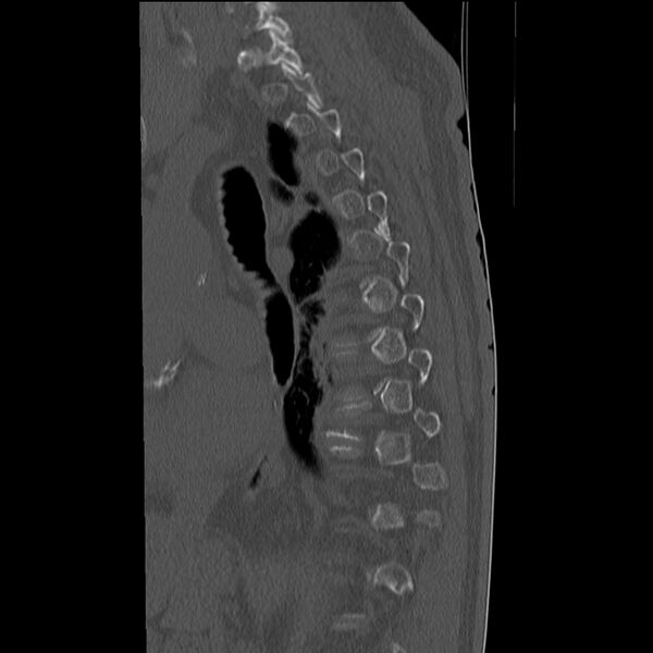 File:Acute and chronic vertebral compression fractures (Radiopaedia 31608-32494 Sagittal bone window 4).jpg